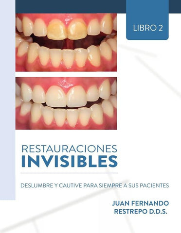 Restauraciones Invisibles: Deslumbre Y Cautive Para Siempre A Sus Pacientes | JUAN FERNANDO  RESTREPO D.D.S.