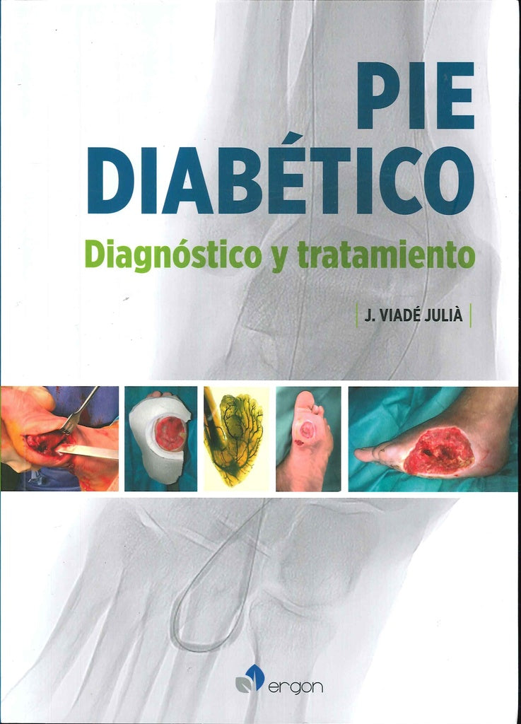 PIE DIABÉTICO. DIAGNÓSTICO Y TRATAMIENTO.. | Viade Julia