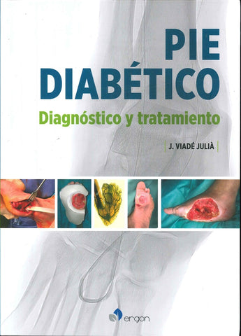 PIE DIABÉTICO. DIAGNÓSTICO Y TRATAMIENTO.. | Viade Julia