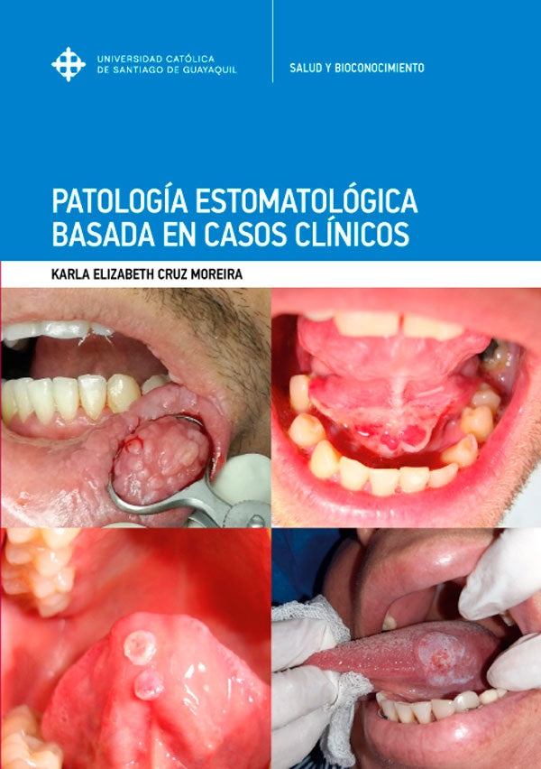 Patología Estomatológica basada en casos clínicos | Karla Elizabeth Cruz Moreira